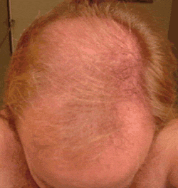 FOLIGAIN Minoxidil 5% Hair Regrowth Treatment For Men 6 Month Supply - FOLIGAIN EUROPE