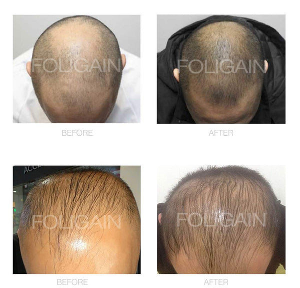 FOLIGAIN Minoxidil 5% Hair Regrowth Foam For Men 6 Month Supply - FOLIGAIN EU