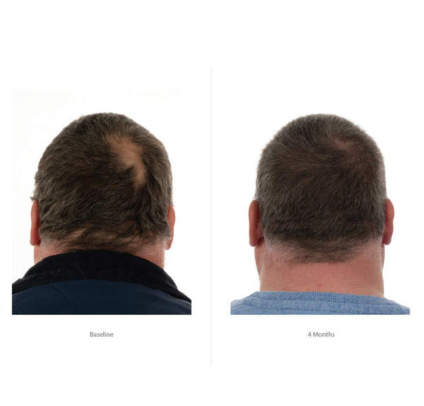 FOLIGAIN Trīskāršās darbības kondicionieris vīriešiem plāniem matiem ar 2% Trioxidil.