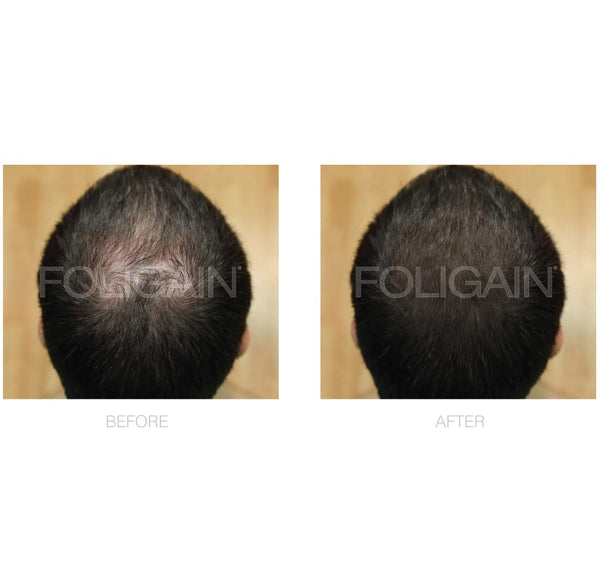 FOLIGAIN Low Alcohol Minoxidil 5% Hair Regrowth Treatment For Men 12 Month Supply - FOLIGAIN EU