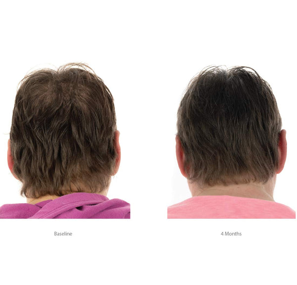FOLIGAIN Trīskāršā darbība kondicionieris plāniem matiem sievietēm ar 2% Trioxidil