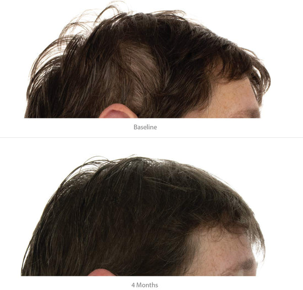 FOLIGAIN Trīskāršās darbības kondicionieris plānām matiem sievietēm ar 2% Trioxidil 473ml